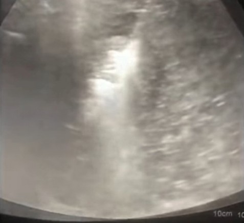 Karaciğerdeki tümör, 10 dakikada yok edildi